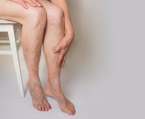 Veja os sinais que podem indicar trombose venosa profunda
