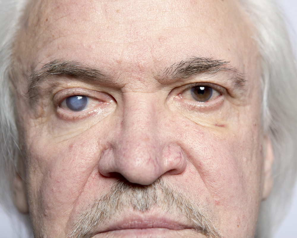 Estresse pode aumentar risco de glaucoma